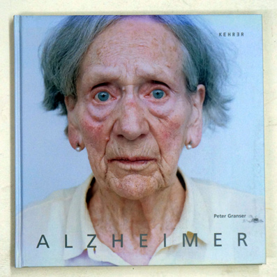 Alzheimer