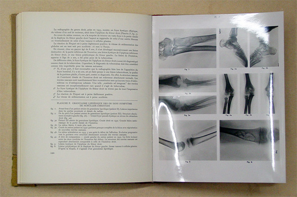 Maladies osseuses