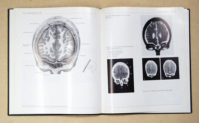 Computed Tomography of the Brain